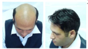 Male Hair Replacement Systems | Hollywood Lace